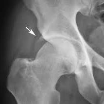 Hip impingement treatment India