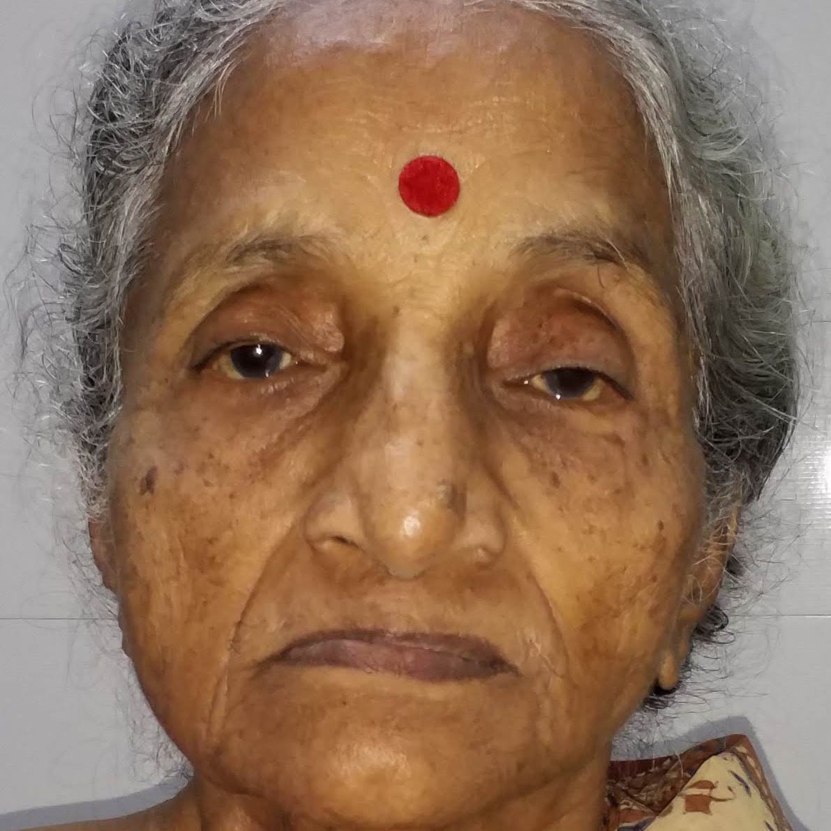 SVF treatment knee osteo-arthritis India