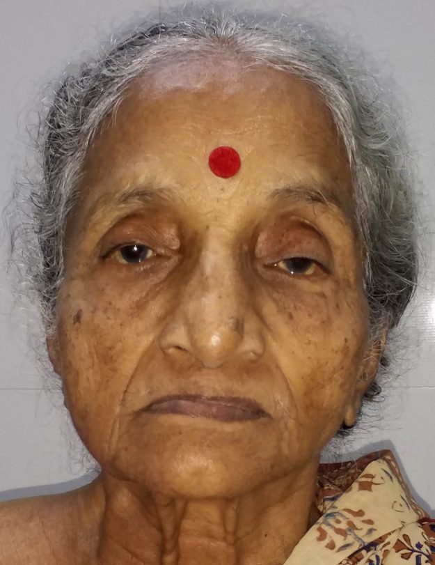 Adipose derived stromal cell treatment knee arthritis India SVF treatment knee osteo-arthritis India