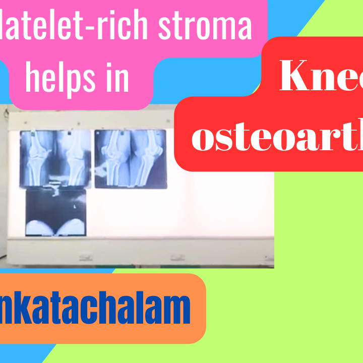 How Platelet-rich stroma helps in knee osteoarthritis
