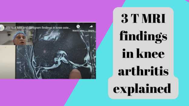Ultrasound-guided Knee PRS injection (1)
