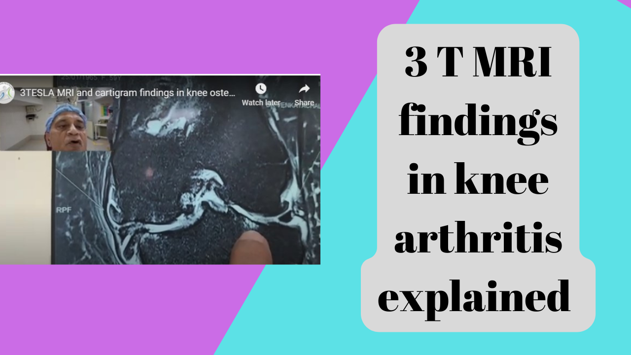 Ultrasound-guided Knee PRS injection (1)