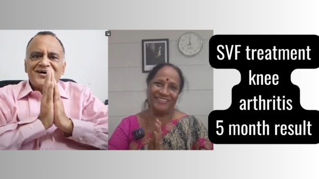 SVF treatment knee arthritis 5 month result